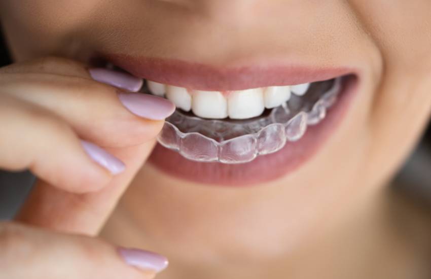 Dental Aligners