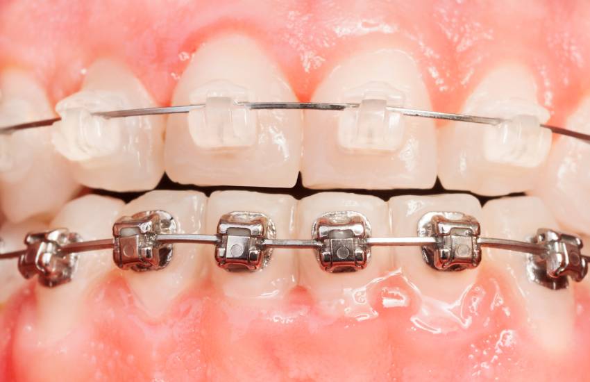 Dental Braces