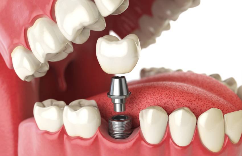 Dental Implants