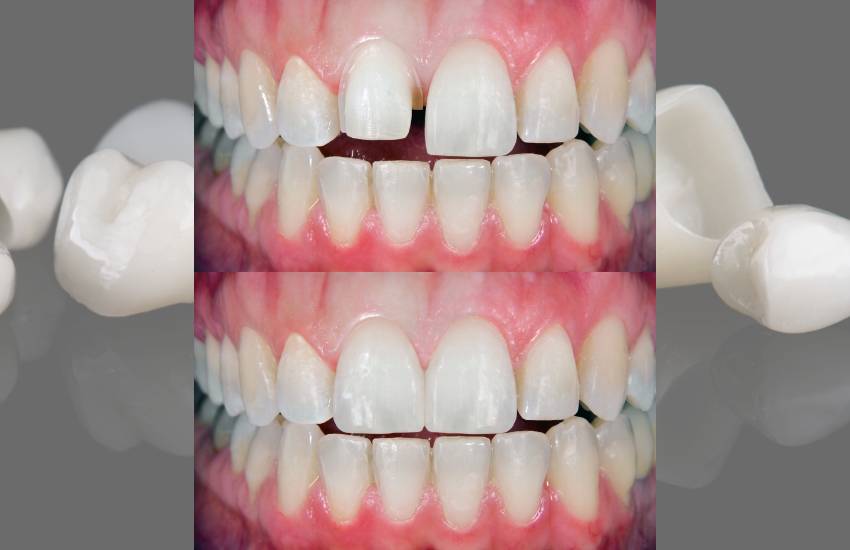 Dental Veneers