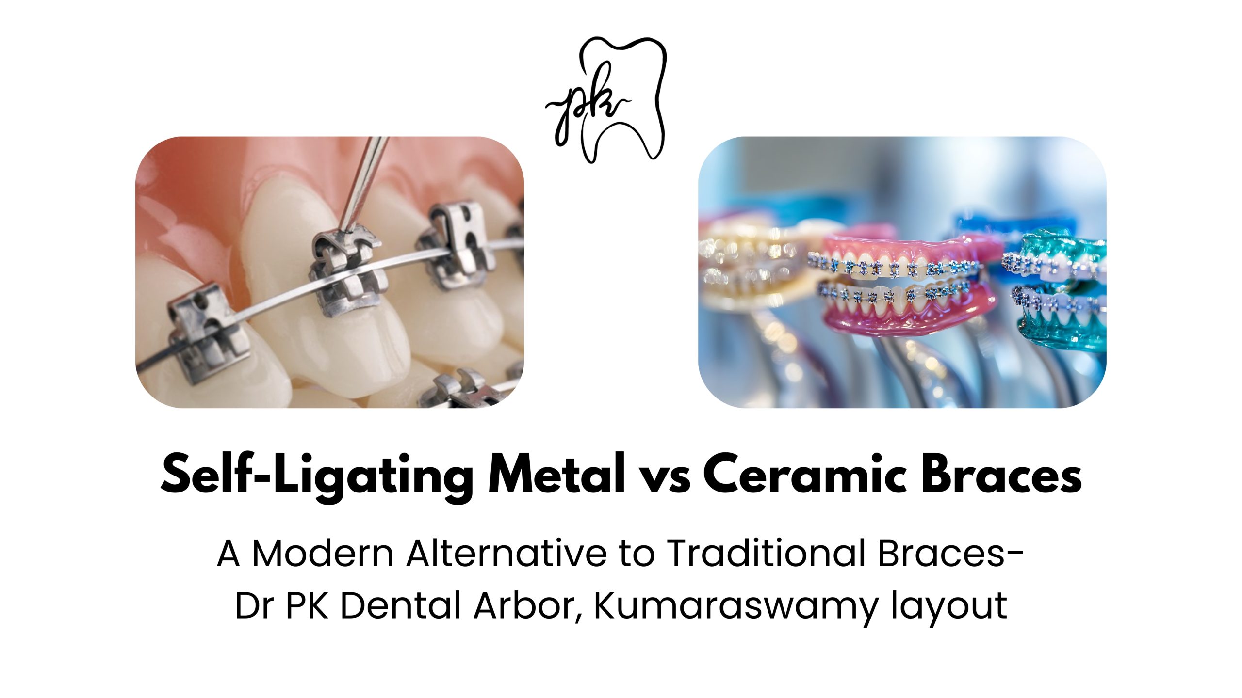 Self-Ligating Metal vs Ceramic Braces: A Modern Alternative to Traditional Braces