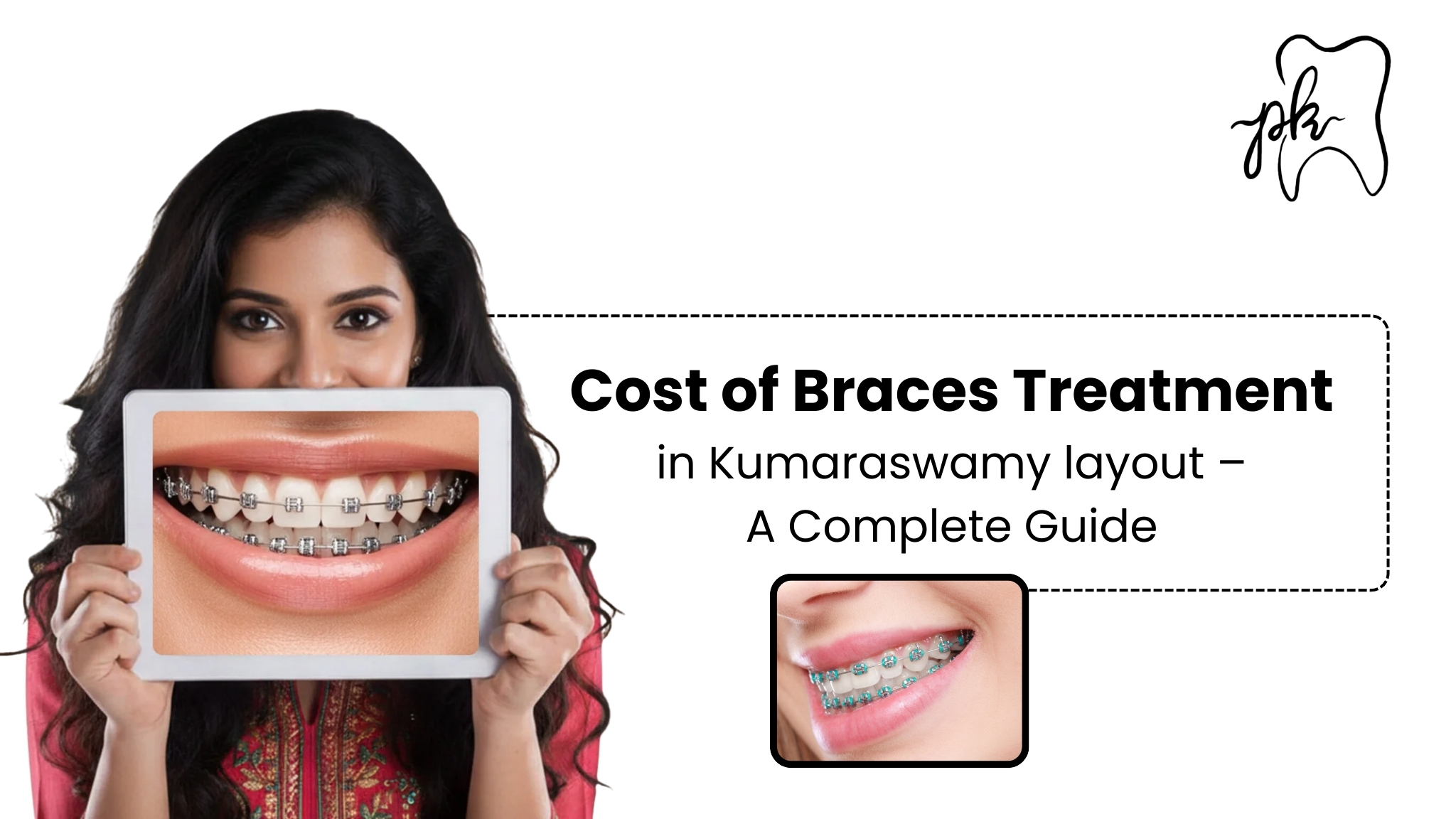 Cost of Braces Treatment in Kumaraswamy Layout – A Complete Guide