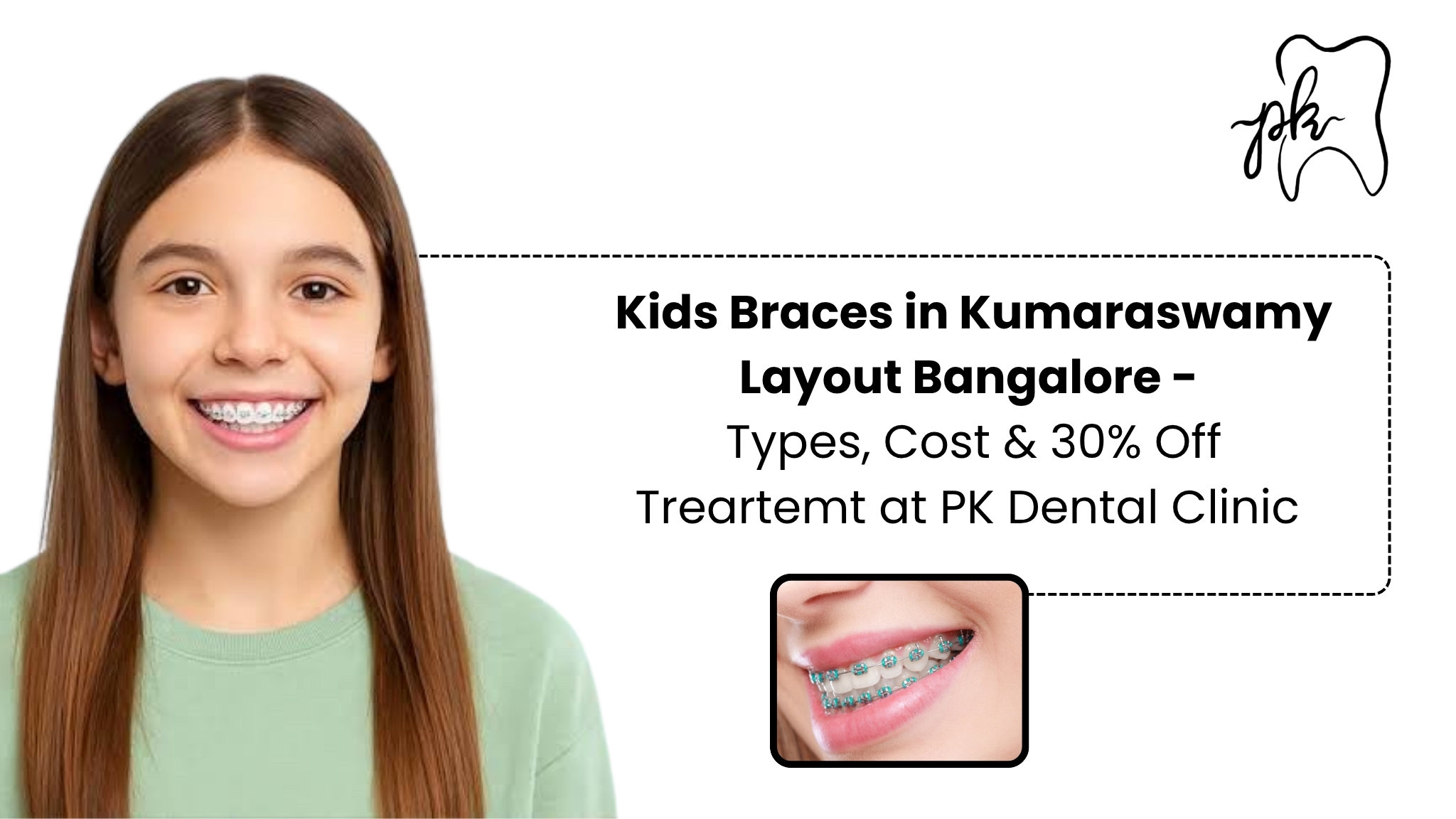 Kids Braces in Kumaraswamy Layout, Bangalore – Types, Cost & 30% Off Treatment at PK Dental Clinic