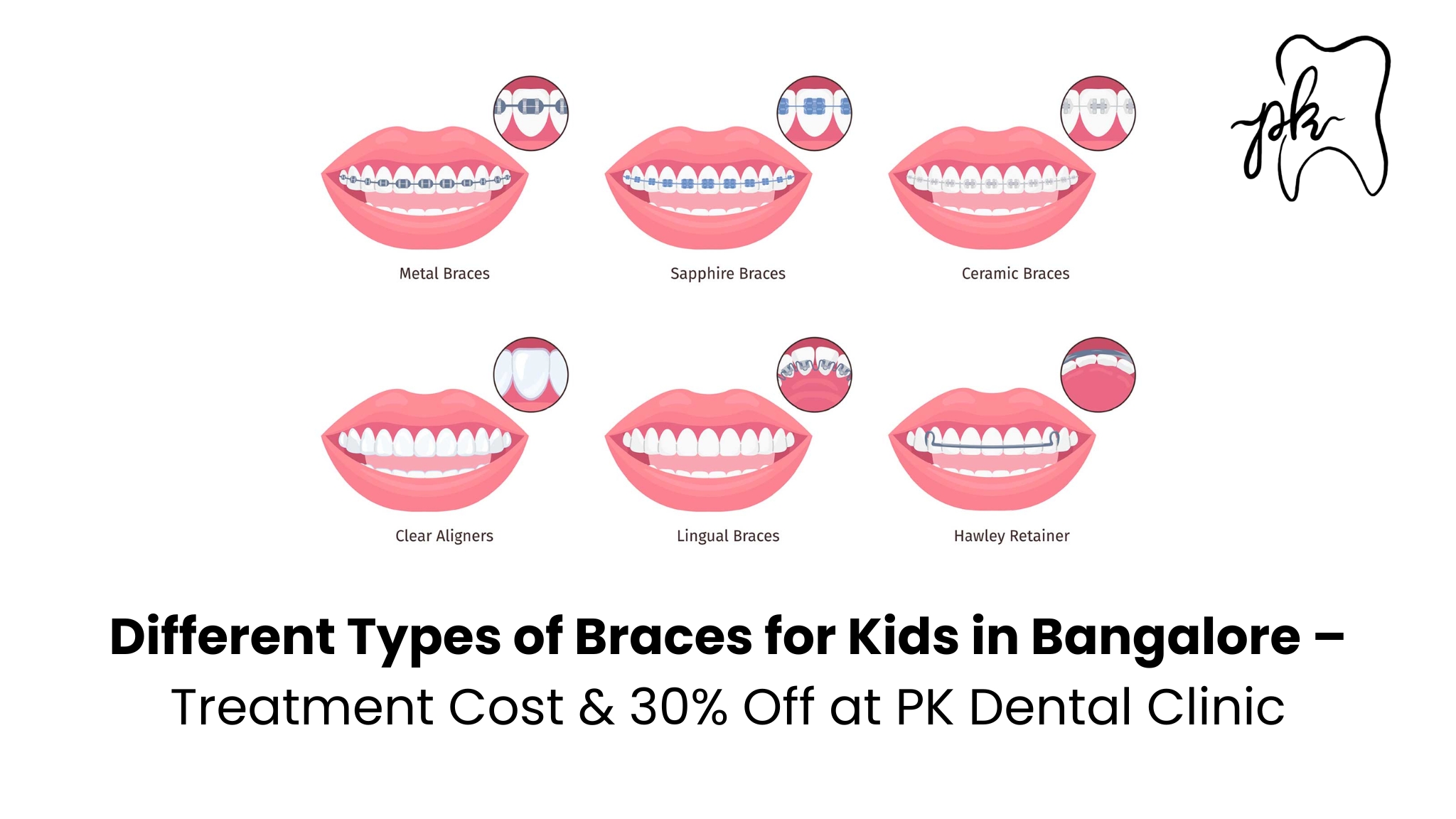 Different Types of Braces for Kids in Bangalore – Treatment Cost & 30% Off at PK Dental Clinic