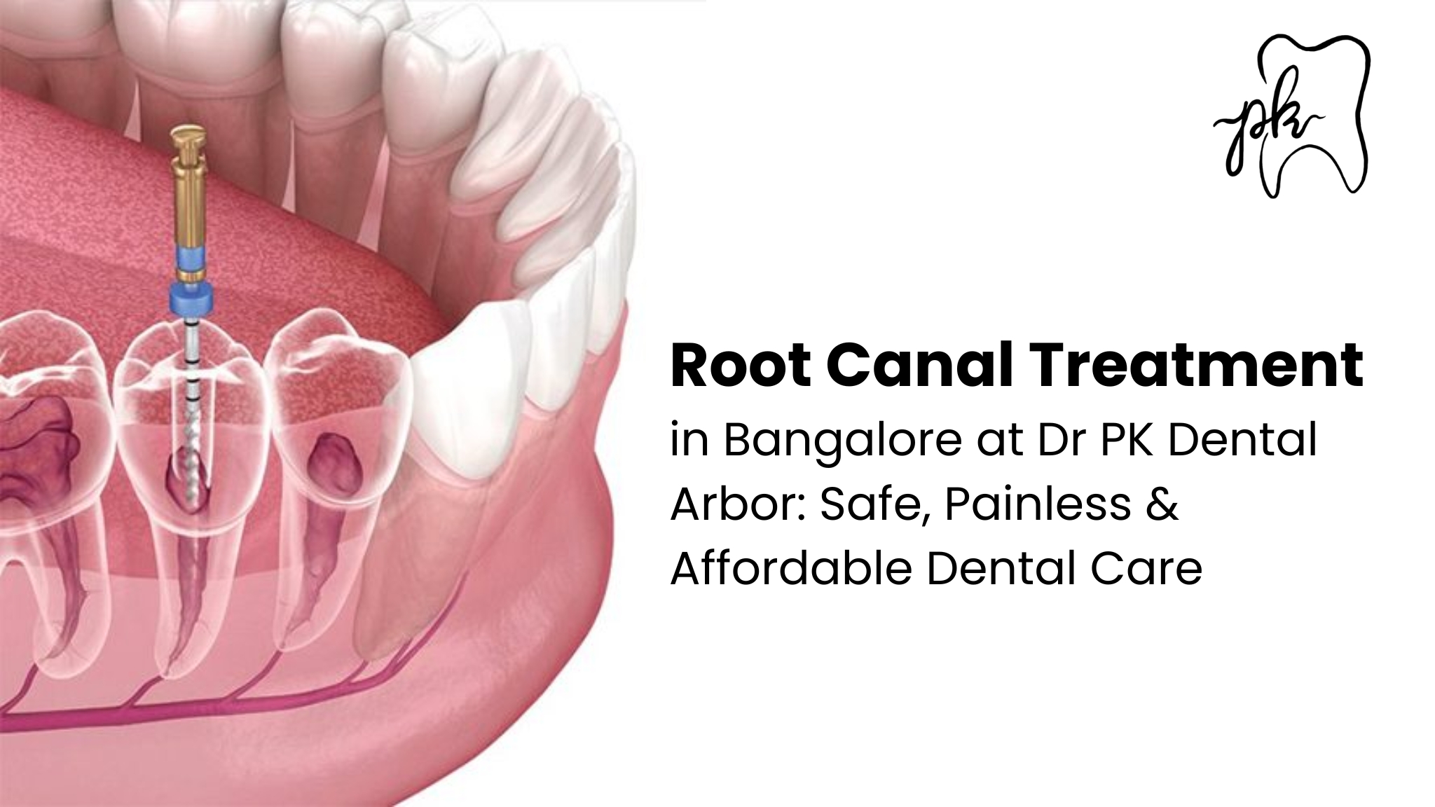 Root Canal Treatment in Bangalore at Dr PK Dental Arbor: Safe, Painless & Affordable Dental Care