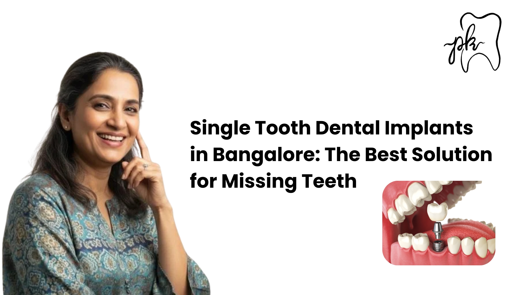 Single Tooth Dental Implants in Bangalore: The Best Solution for Missing Teeth