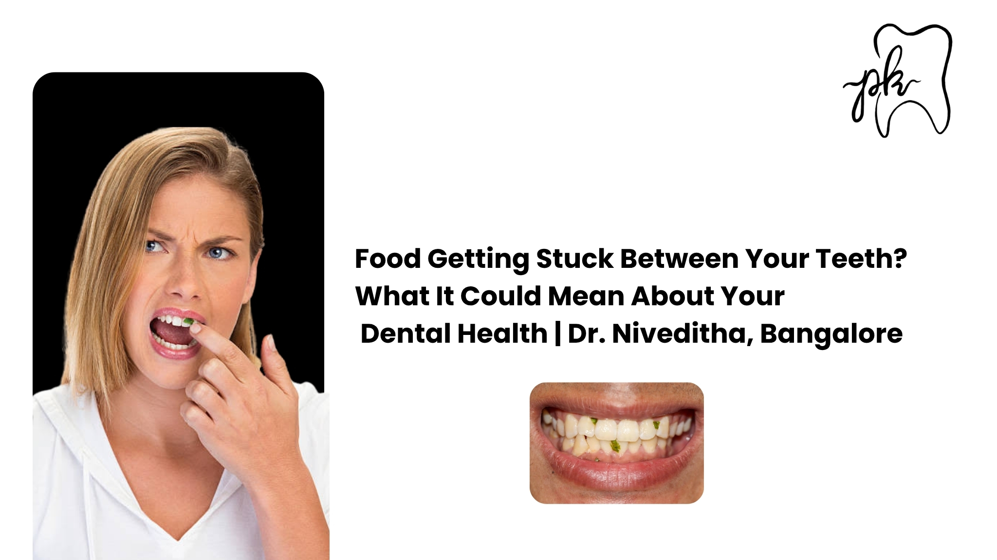 Food Getting Stuck Between Your Teeth? What It Could Mean About Your Dental Health | Dr. Niveditha, Bangalore